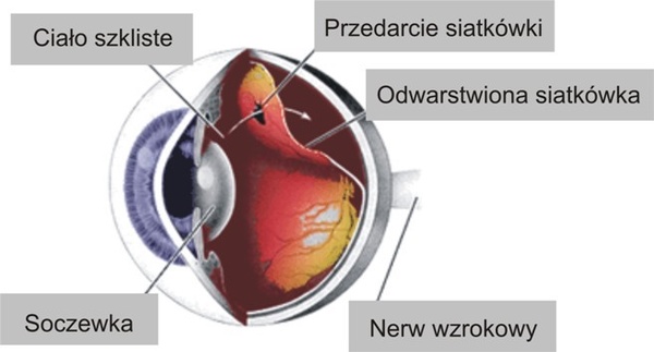 Odwarstwienie siatkówki - nowoczesna diagnostyka i leczenie w Sosnowcu