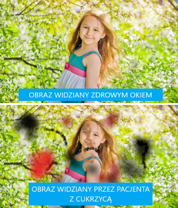 Cukrzyca - nowoczesna diagnostyka i leczenie ocznych powikłań cukrzycy w Sosnowcu